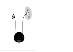 Cystic dysplasia - can affect one or both kidneys