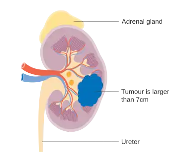 Stage 2 kidney cancer