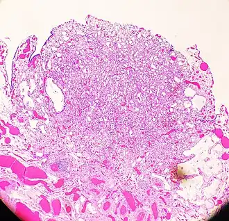 An adenomatoid tumor of the fallopian tube, low magnification, displaying infiltrative-like borders.