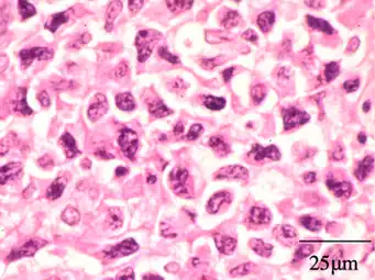 Extranodal NK/T cell lymphoma, nasal type for comparison.[17] These lymphoma cells are typically monotonous, with folded nuclei, indistinct nucleoli and moderate amount of cytoplasm.[18]