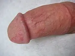 A circumcised penis with an inflamed glans