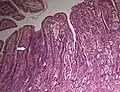 Adenocarcinoma