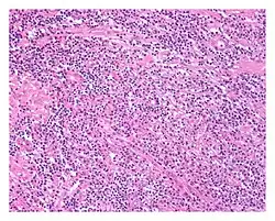 Low power view of IgG4-related prostatitis
