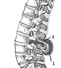 Myelomeningocele in the lumbar area (1) External sac with cerebrospinal fluid (2) Spinal cord wedged between the vertebrae
