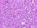 Salt-and-pepper chromatin (pheochromocytoma). H&E stain.