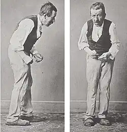 Side and front views of a Parkinson's patient, illustrating hunched posture