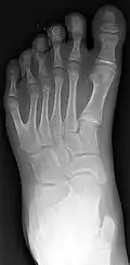 Left foot with postaxial polydactyly of 5th ray