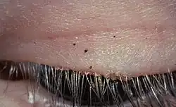 Pubic lice on the eyelashes