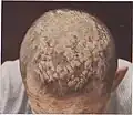 Psoriasis of the scalp