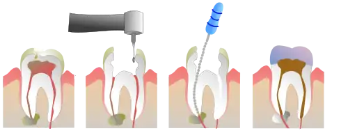 Root Canal Illustration Molar