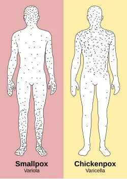 In contrast to the rash in smallpox, the rash in chickenpox occurs mostly on the torso, spreading less to the limbs.