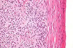 High magnification micrograph of a thecoma. H&E stain.
