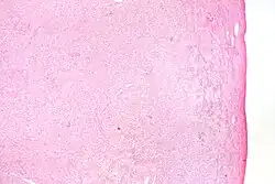 Low magnification micrograph of a thecoma. H&E stain.
