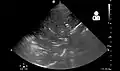 Pneumonia seen by ultrasound[78]