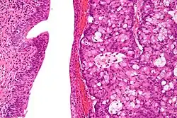 High magnification micrograph of a urachal carcinoma. H&E stain