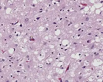 Image 28Magnified 100X, and stained with H&E (hematoxylin and eosin) staining technique, this light photomicrograph of brain tissue reveals the presence of prominent spongiotic changes in the cortex, and loss of neurons in a case of variant Creutzfeldt-Jakob disease (vCJD). (from Agricultural safety and health)